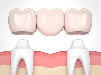 denteal-bridge-genc-dental-istanbul-turkey