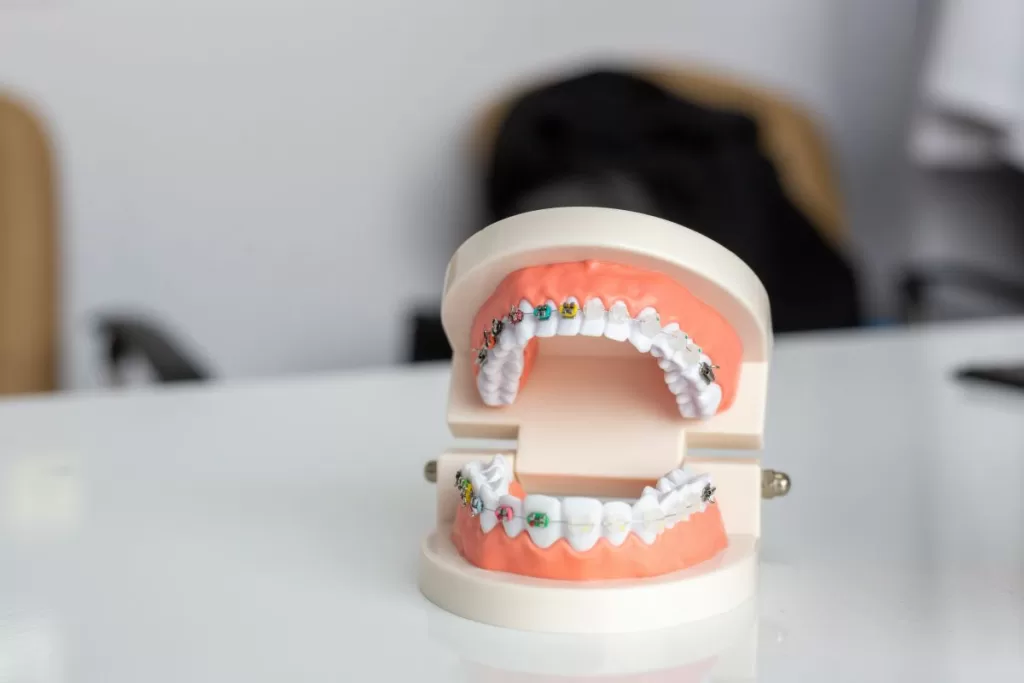 Modern Orthodontics Braces