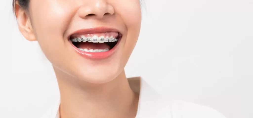 Top Orthodontic Treatments For Your Perfect Smile Jpg