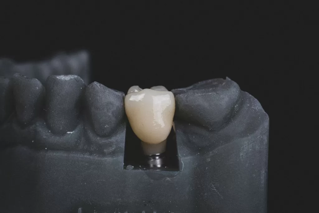 ooth Replacement Options: Implants, Bridges, and Dentures
