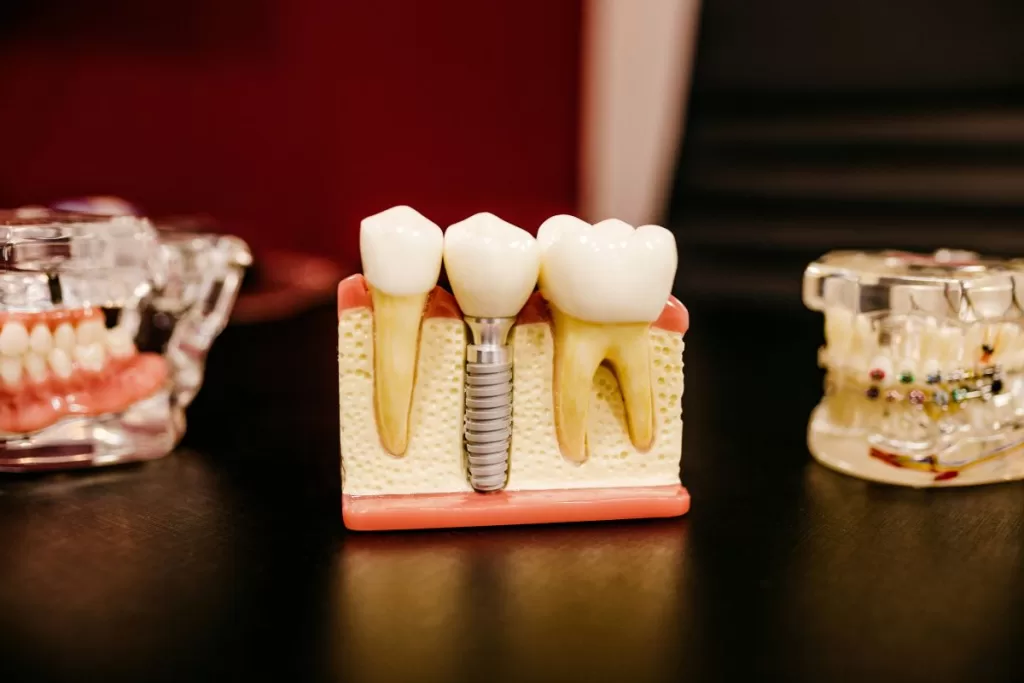 ooth Replacement Options: Implants, Bridges, and Dentures
