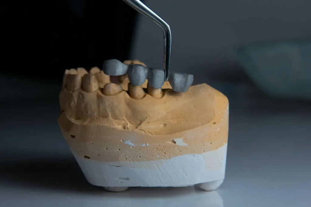 dental-bonding-vs-veneers-which-option-is-right