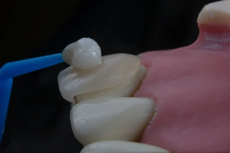 signs-you-may-need-a-dental-night-guard