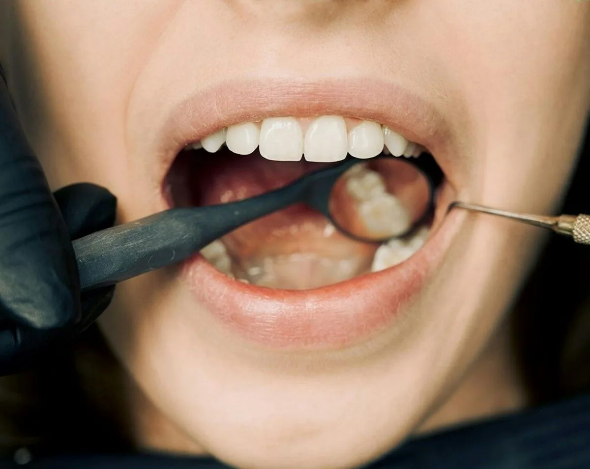 signs-of-your-dental-filling-needs-to-be-replaced